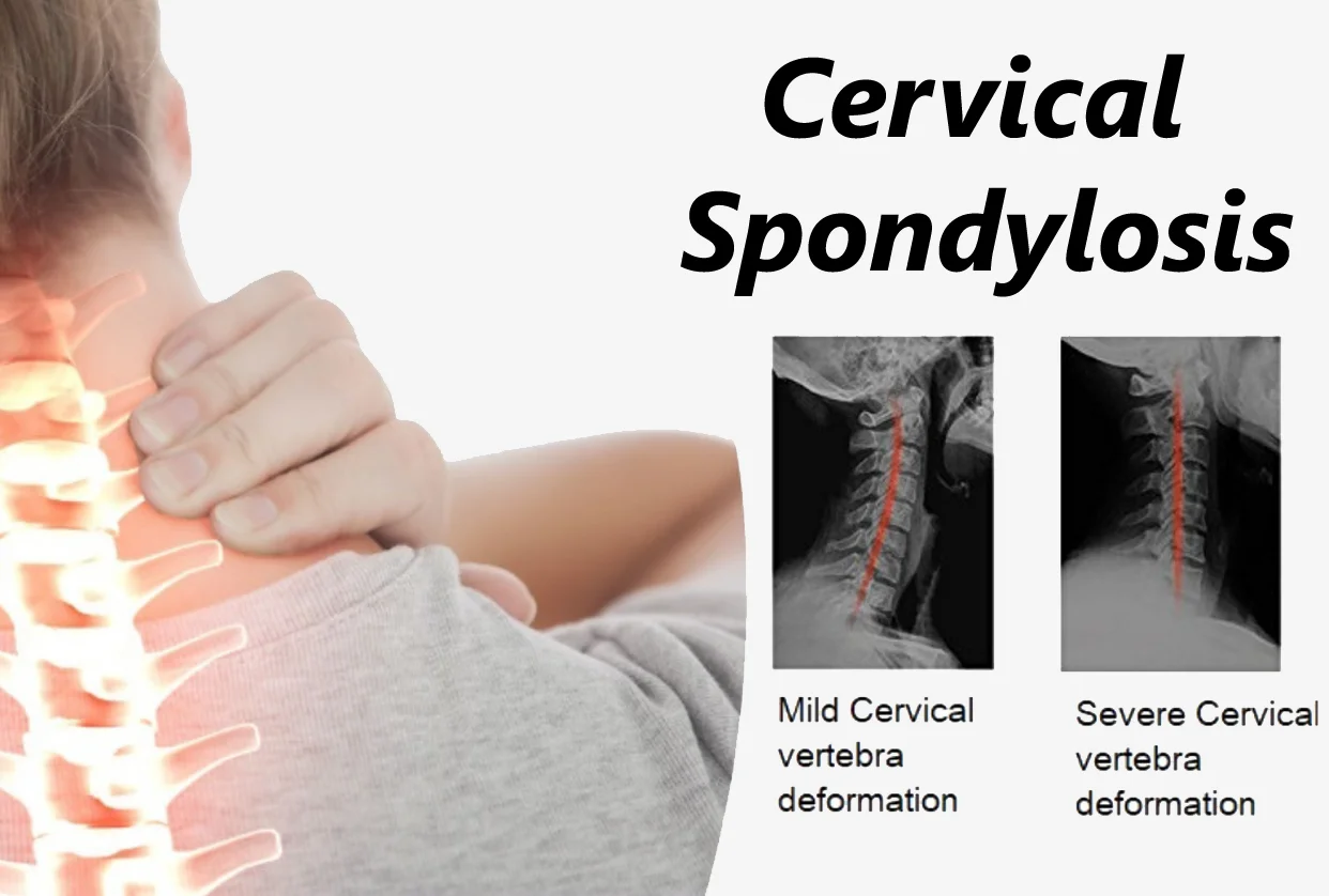 Cervical Spondylitis
