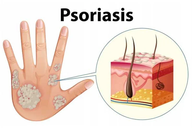 Psoriasis