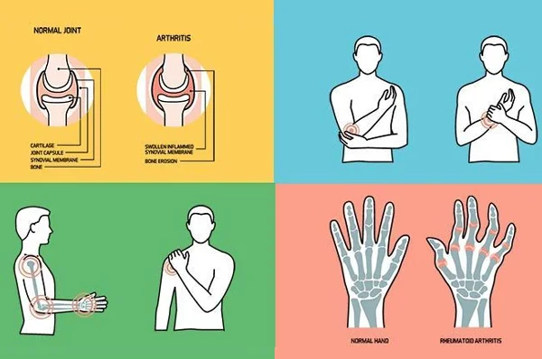 Arthritis