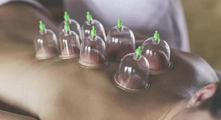 Cupping Therapy